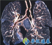 你知道什么是塵肺病嗎？使用粉塵儀可以降低塵肺病的發(fā)生率